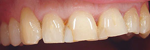 Veneer